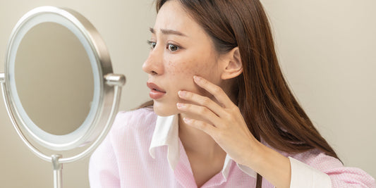 Hyperpigmentation- All you need to know!