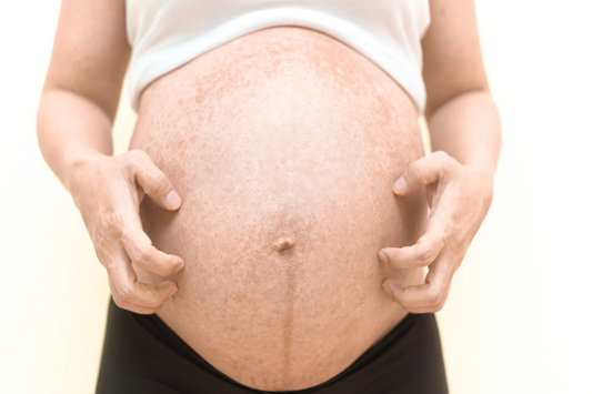 A Guide to Preventing Stretch Marks During Pregnancy: Embracing Healthy Skin